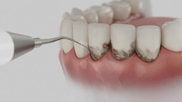 Trusted Wisdom Tooth Removal service in Staunton, VA - Dentist Open Now